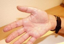 ¿Qué es la hiperhidrosis? hiperhidrosis, manos sudadas