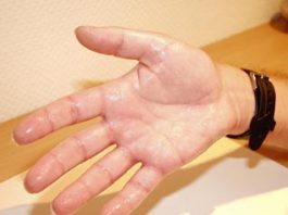 hiperhidrosis, manos sudadas