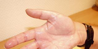 hiperhidrosis, manos sudadas