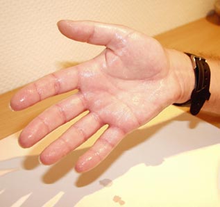 hiperhidrosis, manos sudadas