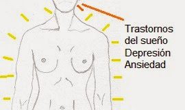 fibromialgia