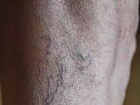 ¿Cómo prevenir las várices? várices