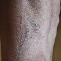 ¿Cómo prevenir las várices? várices