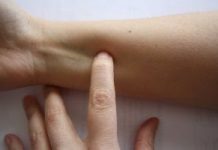 Acupuntura sin agujas: ¿es Acupuntura?