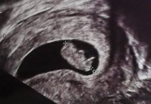 Acupuntura en el embarazo Acupuntura y embarazo