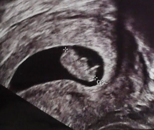 Acupuntura y embarazo