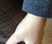 Acupuntura y dolor crónico Dolor de rodilla