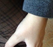 Dolor de rodilla