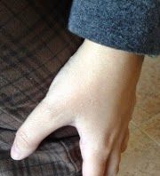 Dolor de rodilla