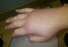 Angioedema Hereditario por déficit de C1 Inhibidor Angioedema