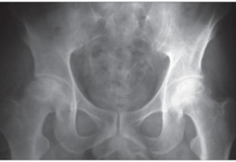 Osteonecrosis de Cadera osteonecrosis de cadera
