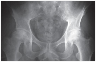 osteonecrosis de cadera