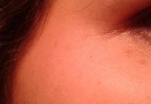 Manchas en la piel, acné y arrugas piel
