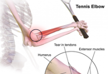 Dolor de codo, causas y tratamientos dolor de codo