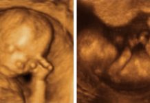 Ecografías 4 D: ¿Para qué sirven? Ecografía 4D de 12 semanas