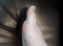 Dolor de talón, causas y tratamiento