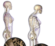 ¿Se puede prevenir la osteoporosis?