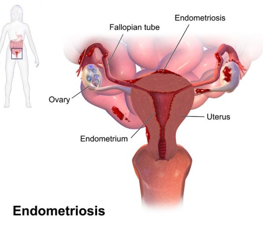 Endometriosis