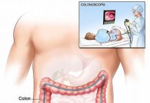 ¿Qué es una endoscopia? Colonoscopia endoscopia