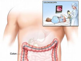 Colonoscopia endoscopia