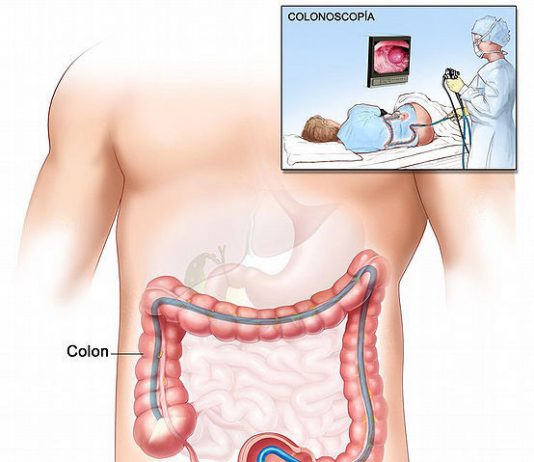 Colonoscopia endoscopia