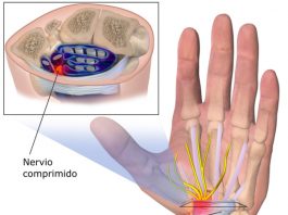Sindrome del tunel carpiano