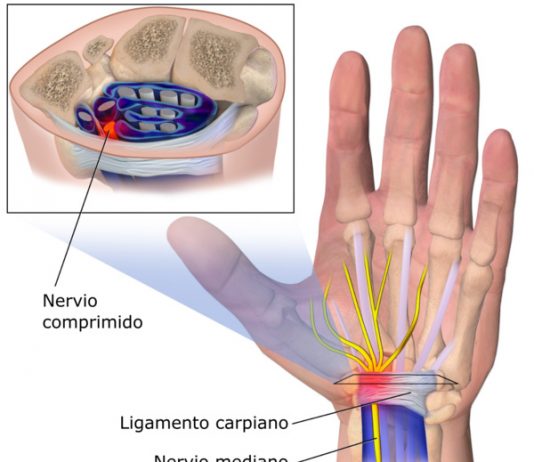 Sindrome del tunel carpiano