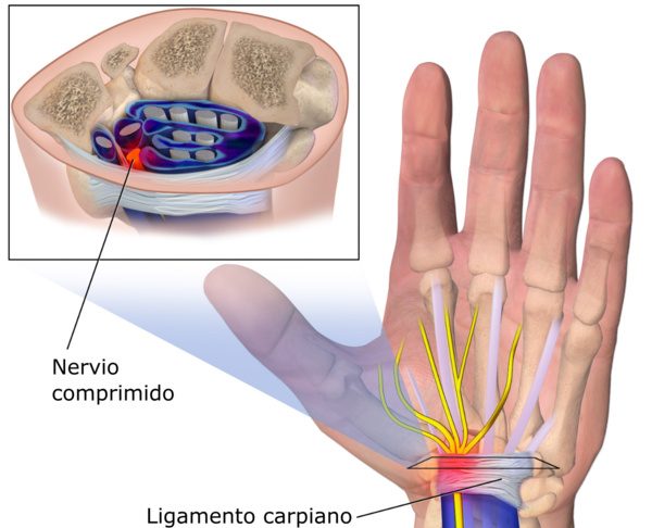 Sindrome del tunel carpiano