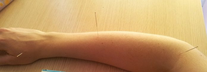 Acupuntura contralateral Acupuntura contralateral