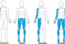 ¿Qué es la parálisis cerebral? Tipos de parálisis