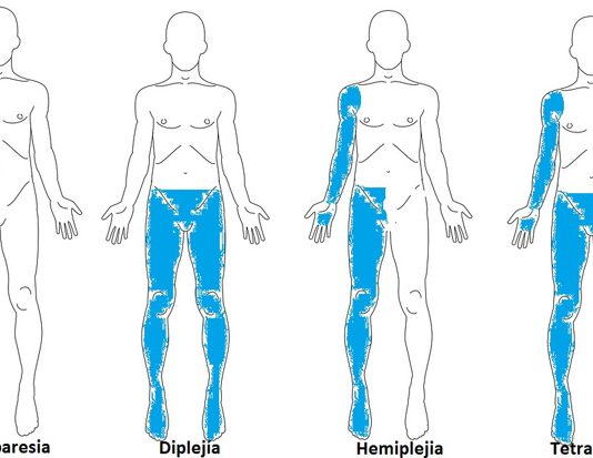 ¿Qué es la parálisis cerebral? Tipos de parálisis