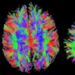 neuropsicología Resonancia magnética del cerebro