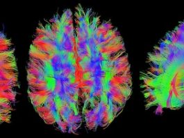 neuropsicología Resonancia magnética del cerebro