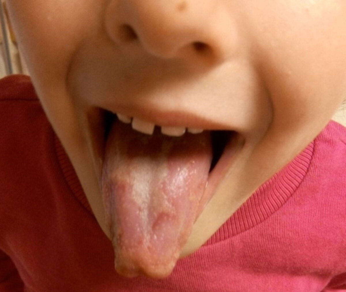lengua geografica en los niños lengua geografica en los niños