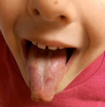 Lengua geográfica de un niño