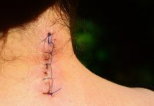 Tratamiento del dolor postoperatorio con acupuntura Dolor postoperatorio: sutura sobre cuello