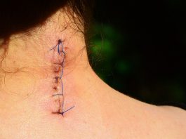 Tratamiento del dolor postoperatorio con acupuntura Dolor postoperatorio: sutura sobre cuello