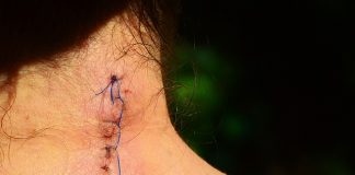 Dolor postoperatorio: sutura sobre cuello