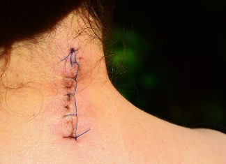 Dolor postoperatorio: sutura sobre cuello