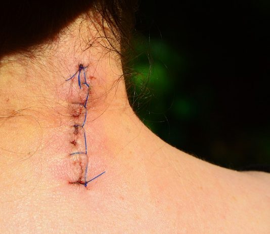 Tratamiento del dolor postoperatorio con acupuntura Dolor postoperatorio: sutura sobre cuello