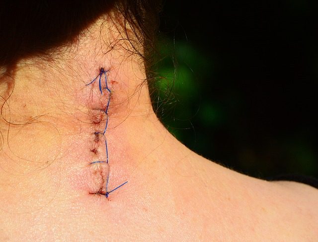 Dolor postoperatorio: sutura sobre cuello
