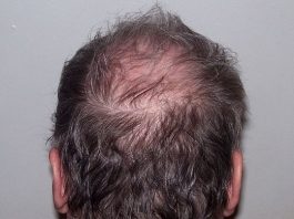 alopecia