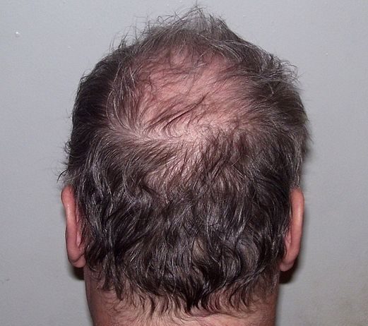 alopecia