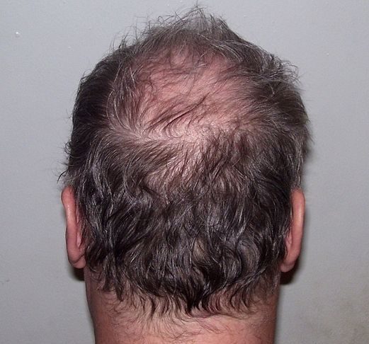 alopecia