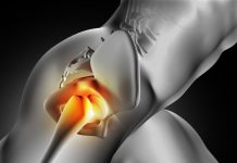 Trocanteritis, síntomas y tratamiento Trocanteritis