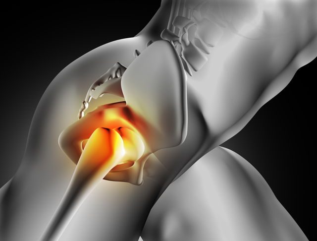 Trocanteritis, síntomas y tratamiento Trocanteritis