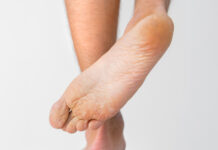 Dishidrosis plantar y palmar: causas y mejores remedios deshidrosis plantar